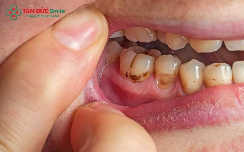 Khi vi khuẩn sâu răng tấn công xuống chóp răng gây áp xe, người bệnh có thể đối mặt với những cơn đau dữ dội và tình trạng sưng mặt nghiêm trọng
