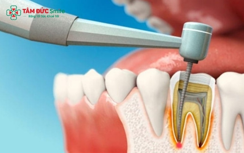 Tùy vào mức độ tổn thương, bác sĩ sẽ chỉ định trám răng thẩm mỹ, bọc sứ hoặc bắt buộc phải nhổ bỏ để bảo vệ các răng lân cận.