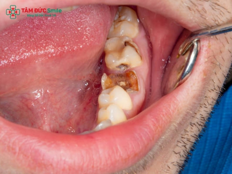 Tác hại của sâu răng và cách điều trị