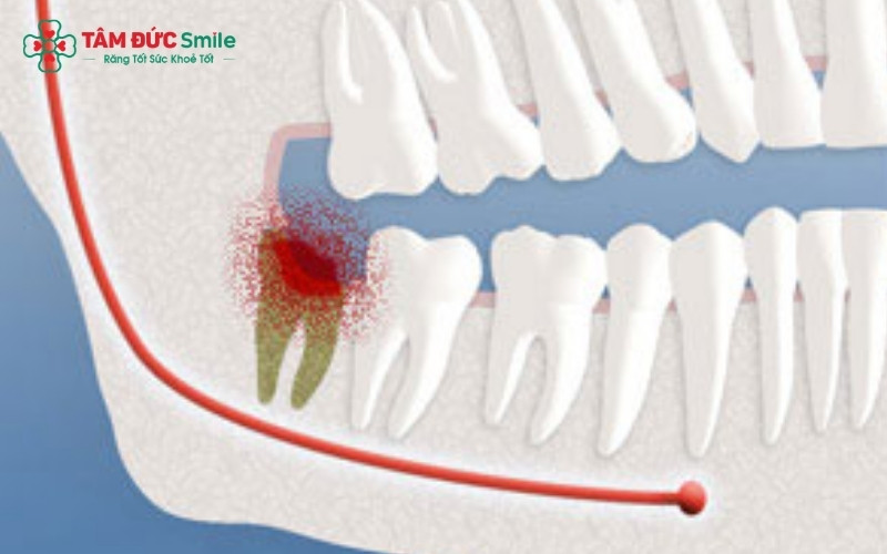 Việc phải há miệng lâu trong quá trình nhổ răng và tình trạng sưng viêm mô mềm xung quanh là nguyên nhân chính gây ra cảm giác cứng hàm, khó há miệng