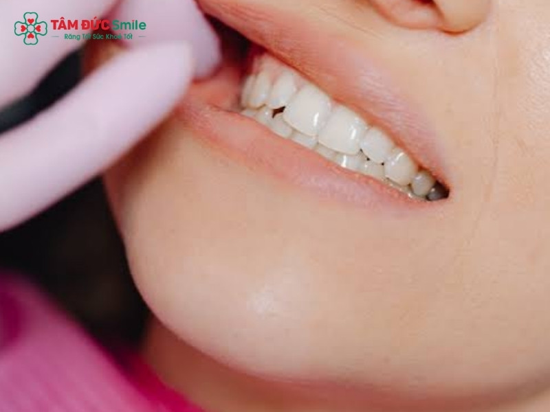 Tập há miệng sau khi nhổ răng khôn đúng cách và an toàn