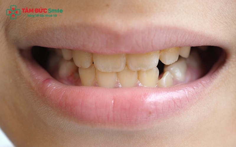 Các lỗ li ti trên men răng sau khi tẩy trắng rất dễ hấp thụ sắc tố từ thực phẩm đậm màu, khiến răng nhanh chóng xỉn màu trở lại.