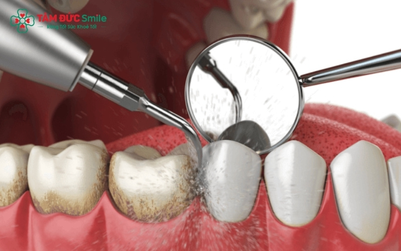 Ưu tiên các thực phẩm màu trắng và sử dụng ống hút khi uống nước đậm màu là bí quyết giữ răng trắng sáng bền lâu.