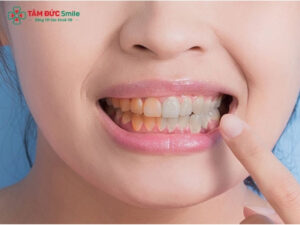 Vì sao tẩy trắng răng xong bị vàng lại? Cách chăm sóc răng sau khi tẩy trắng để hạn chế vàng lại