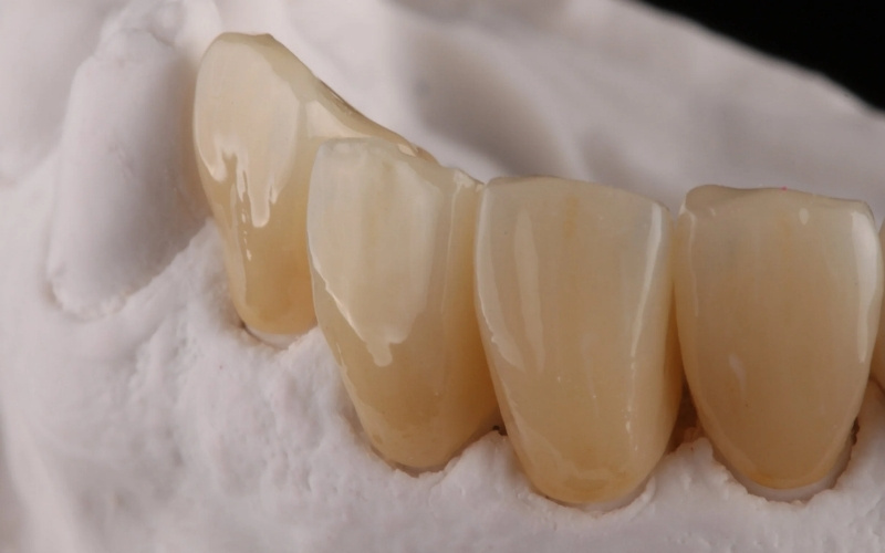 Các dòng phôi sứ Katana Zirconia với công nghệ đa lớp giúp tạo nên màu sắc sống động, phù hợp với từng nhu cầu phục hình từ răng cửa đến răng hàm