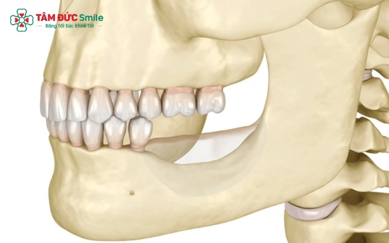 Tiêu xương hàm là tình trạng suy giảm về mật độ, chiều cao và thể tích của xương ổ răng sau khi mất răng hoặc do viêm nhiễm.