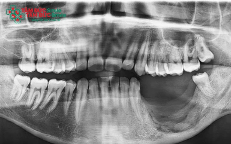 Mất răng lâu ngày là nguyên nhân hàng đầu gây tiêu xương do lực nhai không còn tác động để kích thích xương hàm phát triển.
