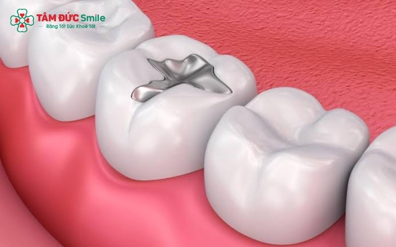 Răng cấm có mặt nhai rộng và nhiều hố rãnh, rất dễ bị sâu hoặc mẻ nhỏ, cần được trám kín sớm để bảo vệ mô răng thật.