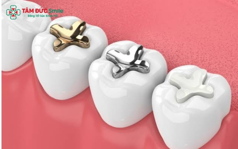 Bên cạnh trám Composite truyền thống, Inlay/Onlay sứ là giải pháp tối ưu cho răng cấm bị vỡ lớn, giúp chịu lực nhai cực tốt và bền màu theo thời gian.