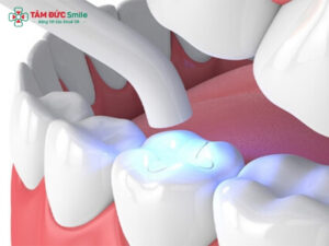 Răng cấm bị sâu có trám được không? Trám răng cấm bền bao lâu?