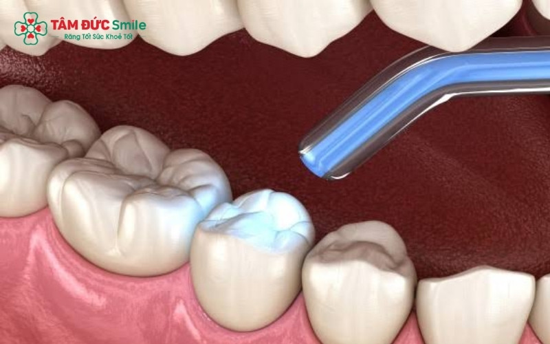Do phải chịu áp lực nhai lớn hàng ngày, miếng trám răng cấm cần được kiểm tra định kỳ để đảm bảo không bị hở kẽ hoặc bong vỡ.