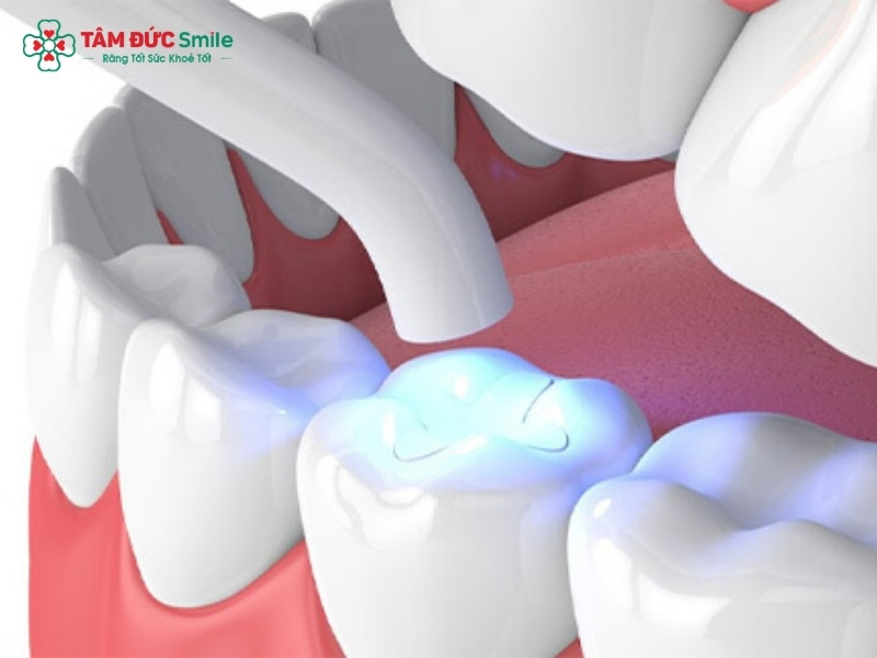 Răng cấm bị sâu có trám được không? Trám răng cấm bền bao lâu?