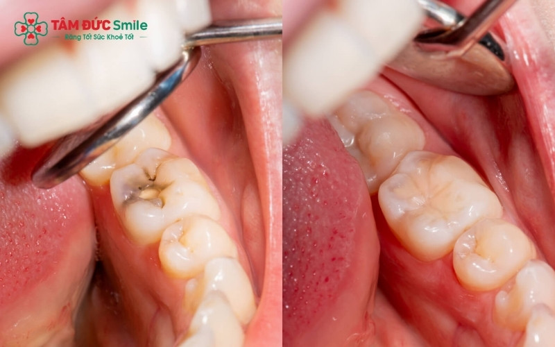 Quy trình trám răng sâu lỗ nhỏ chỉ mất khoảng 15–20 phút, hoàn toàn nhẹ nhàng và không gây đau đớn vì chưa tác động sâu đến dây thần kinh.