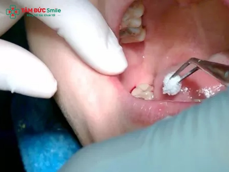 Trám răng lỗ nhỏ có cần thiết không? Lưu ý sau khi trám