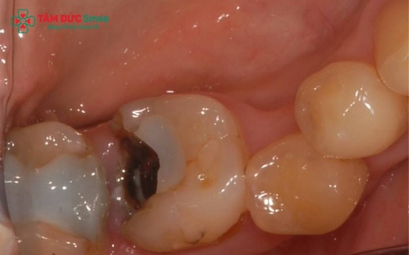 Trám răng sâu nhẹ khi lỗ sâu còn ở giai đoạn men răng giúp bảo tồn tối đa mô răng thật và ngăn chặn vi khuẩn tấn công sâu vào tủy răng.