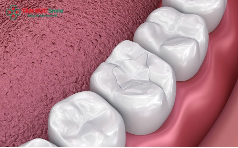 Trám răng bằng Composite là phương pháp phổ biến nhất hiện nay nhờ tính thẩm mỹ cao