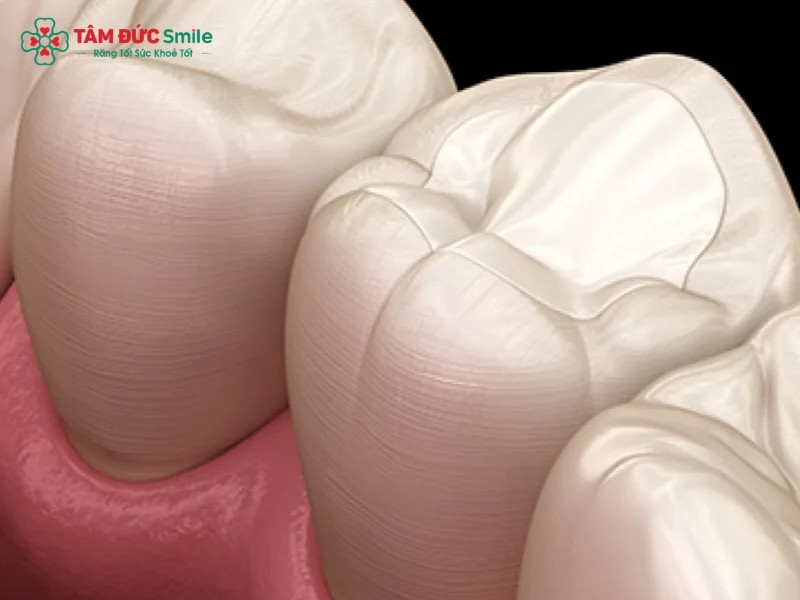Răng sâu nhẹ có nên trám không? Các phương pháp trám răng sâu nhẹ phổ biến