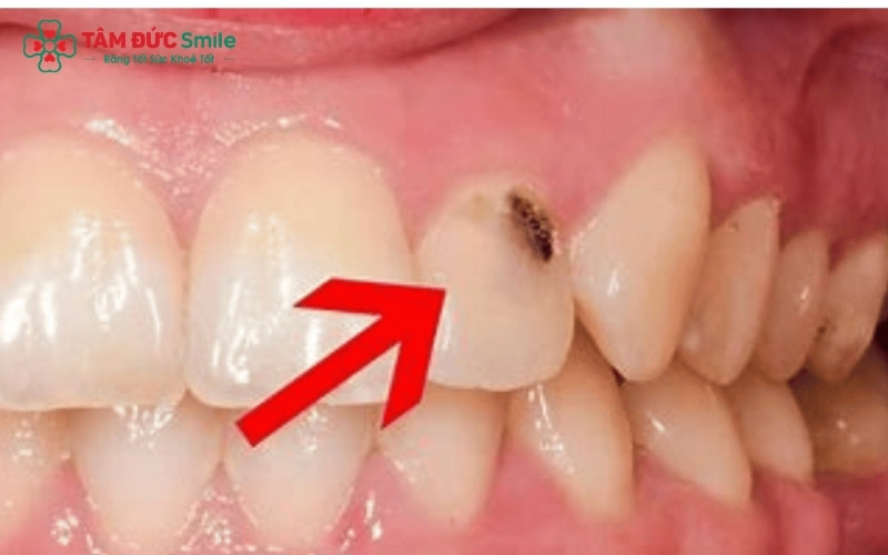 Miếng trám bị hở hoặc mô sâu chưa được làm sạch hoàn toàn là những nguyên nhân hàng đầu khiến răng vẫn đau nhức dai dẳng sau khi trám.