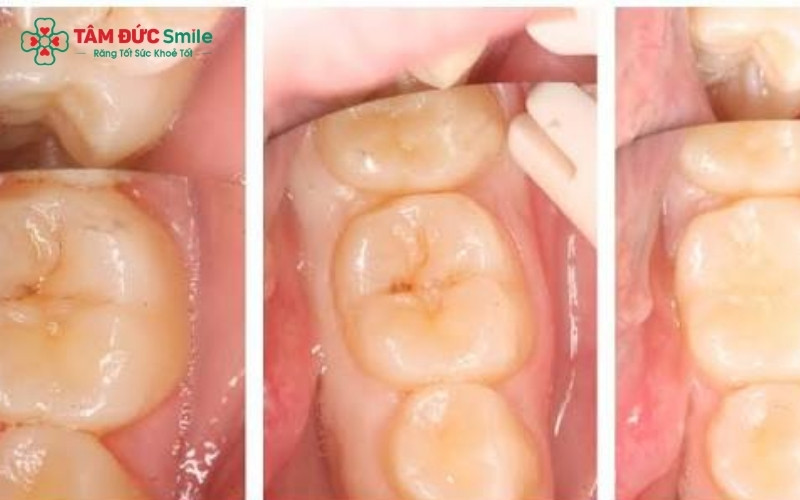 Bọc răng sứ để bảo vệ răng tốt hơn khắc phục tình trạng trám răng bị sâu vẫn đau