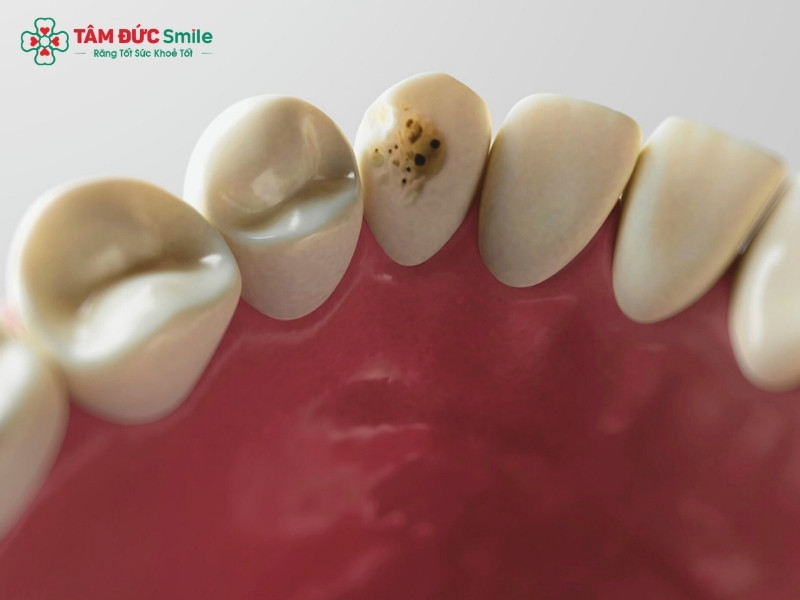 Trám răng sâu rồi mà vẫn đau: Nguyên nhân và cách xử lý