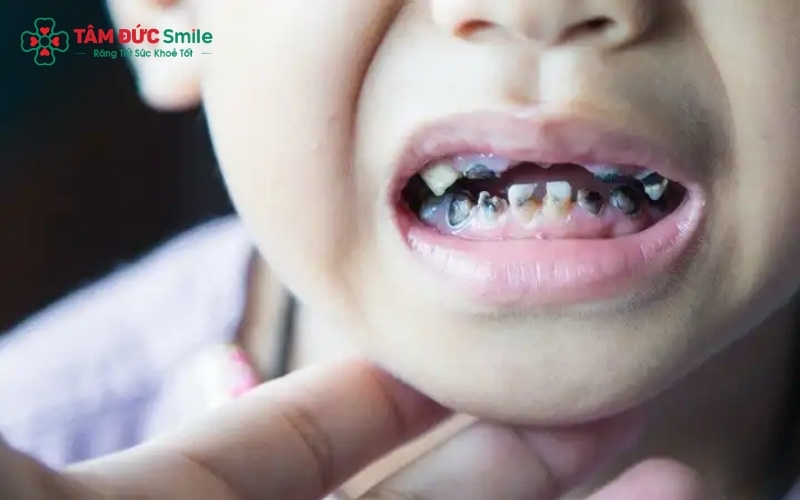 Sâu răng sữa không chỉ gây đau đớn mà còn ảnh hưởng nghiêm trọng đến quá trình mọc răng vĩnh viễn, dễ khiến răng sau này bị mọc lệch, khấp khểnh.