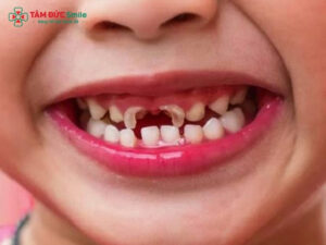 Trẻ 4 tuổi bị sâu răng hàm: Nguyên nhân, dấu hiệu và cách chữa