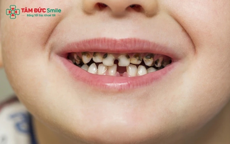 Phụ huynh cần quan sát kỹ mặt nhai răng hàm của trẻ; khi lỗ sâu chuyển sang màu nâu hoặc đen, răng đã bắt đầu bị tổn thương mô cứng và cần được điều trị ngay