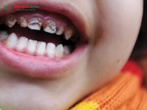Trẻ 5 tuổi bị sâu răng hàm: Nguyên nhân, dấu hiệu và cách điều trị an toàn