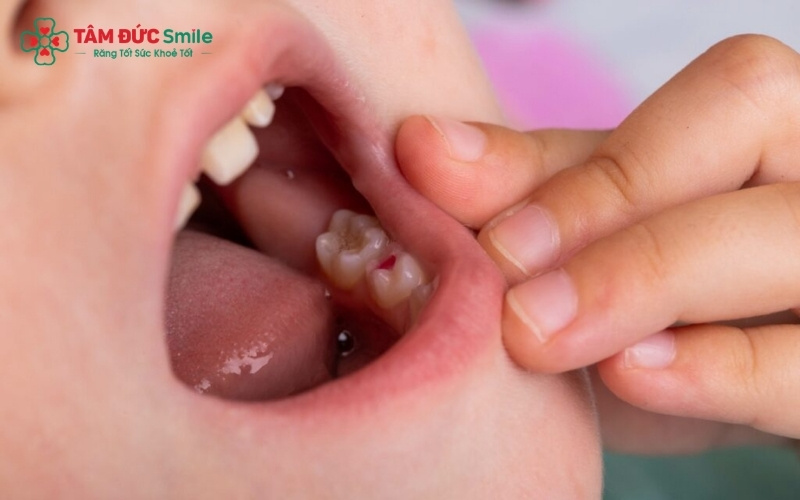 Ở tuổi lên 6, trẻ bắt đầu mọc răng hàm số 6 vĩnh viễn; nếu để sâu hỏng phải nhổ bỏ, răng này sẽ không bao giờ mọc lại,