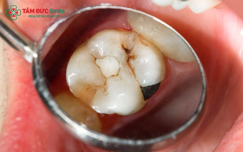 Trám bít hố rãnh là phương pháp hiện đại giúp "lấp đầy" các khe hở trên mặt răng hàm, ngăn chặn vi khuẩn tấn công và bảo vệ răng vĩnh viễn cho trẻ cực kỳ hiệu quả.