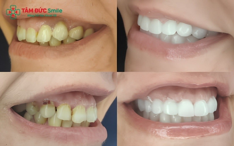 Độ chính xác trong quá trình lấy dấu và tay nghề của bác sĩ là những yếu tố quyết định răng sứ có sử dụng được lâu bền hay không.