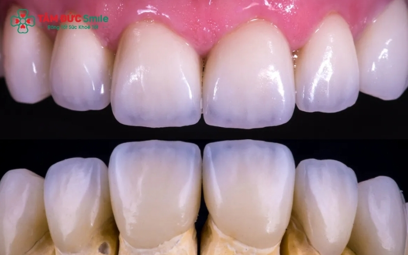 Khi thấy thức ăn thường xuyên mắc vào kẽ răng hoặc nướu bị sưng đau, bạn nên đến nha khoa để kiểm tra độ sát khít của mão sứ.