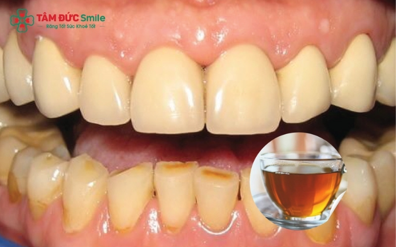 Sử dụng ống hút và uống thêm nước lọc ngay sau khi dùng trà là những mẹo đơn giản giúp hạn chế tối đa thời gian tiếp xúc của sắc tố màu với bề mặt răng.