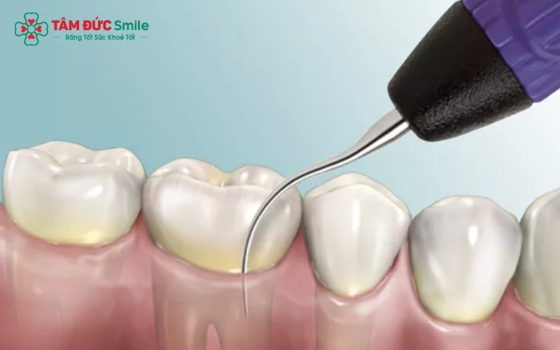 Cạo vôi và đánh bóng chuyên sâu tại nha khoa giúp loại bỏ hoàn toàn các vết bám cứng đầu do trà mà việc đánh răng thông thường không thể làm sạch được