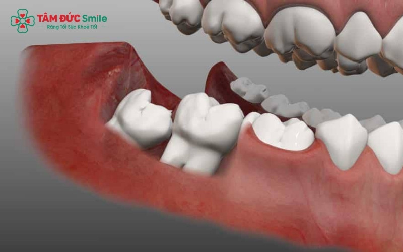 Nếu không điều trị sớm, ổ viêm quanh thân răng khôn có thể lan rộng làm tiêu xương hàm và làm hỏng răng số 7 khỏe mạnh