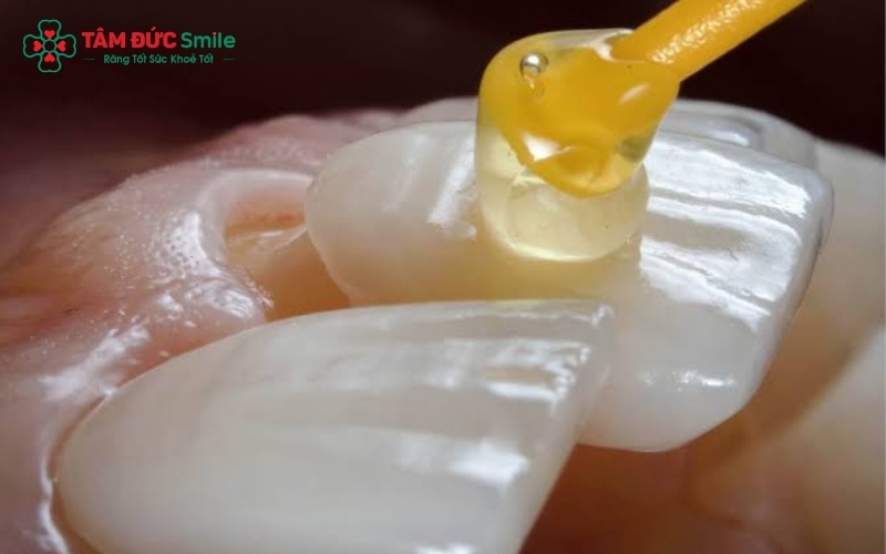 Xi măng nha khoa đóng vai trò là lớp "keo" đặc biệt kết nối vững chắc giữa răng thật và răng sứ.
