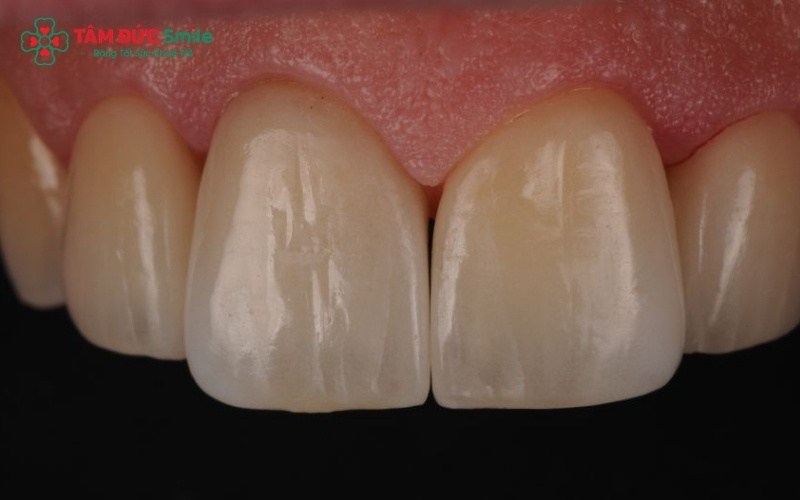 Xi măng chuyên dụng được ứng dụng linh hoạt từ dán mặt sứ Veneer mỏng đến các cầu răng sứ phức tạp.