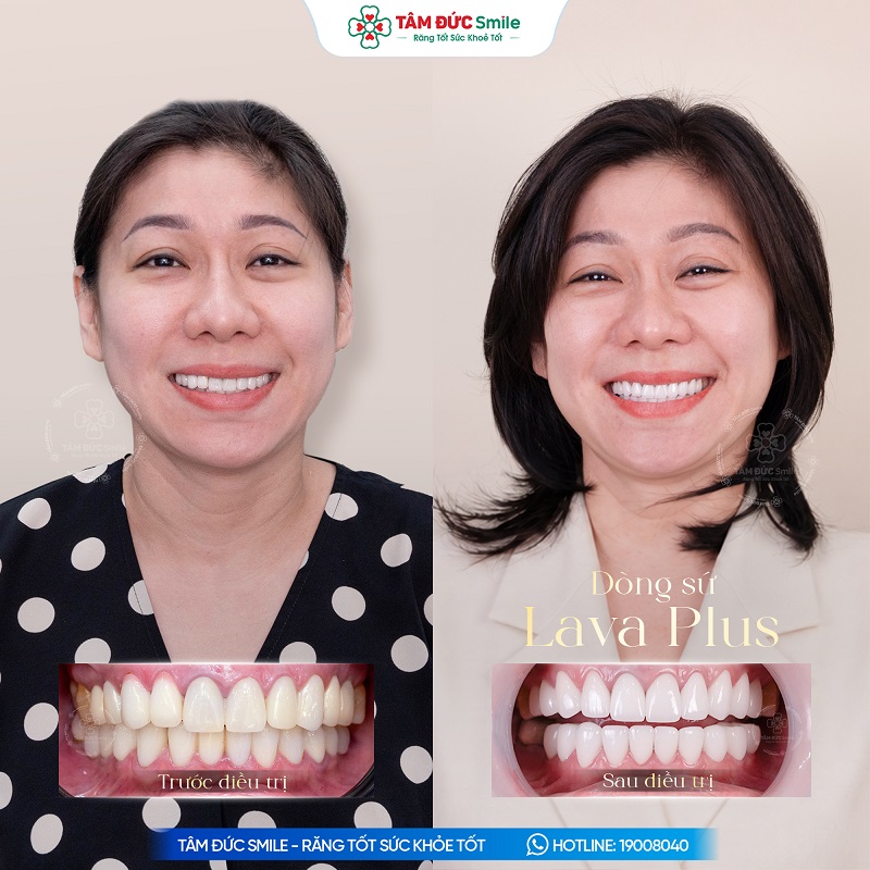 Bọc răng sứ có thể cải thiện màu sắc, hình dáng và chức năng răng, nhưng cần thực hiện đúng chỉ định để hạn chế ê buốt, cộm khớp cắn hoặc viêm nướu.