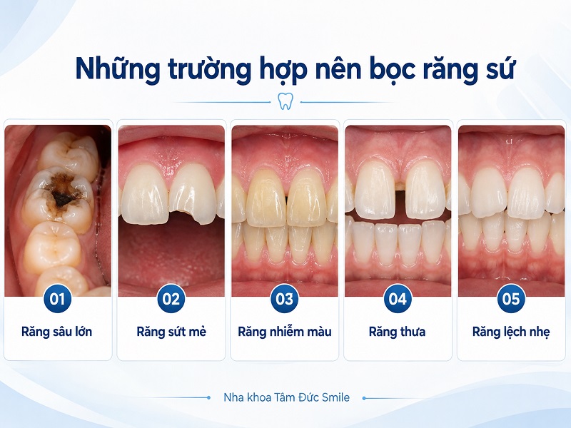 Một số trường hợp răng thưa nhẹ, sứt mẻ, nhiễm màu hoặc hình thể chưa cân đối có thể được bác sĩ chỉ định bọc sứ