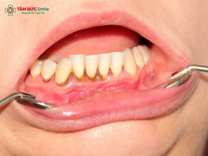 Mảng bám vàng, nâu hoặc đen quanh chân răng là dấu hiệu cần kiểm tra cao răng.