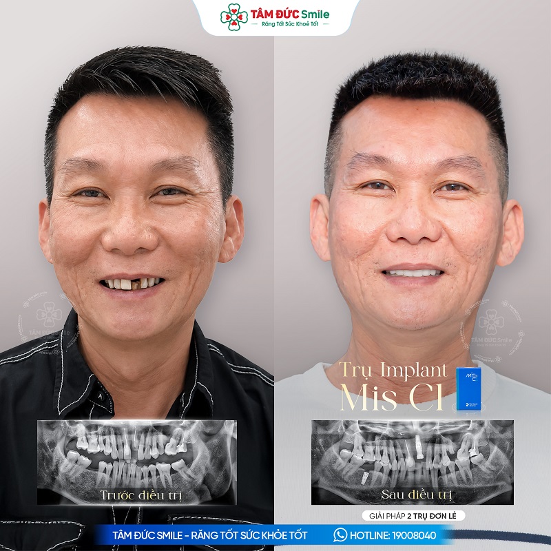 Cấy Implant đơn lẻ giúp phục hồi răng mất mà không cần mài răng kế cận