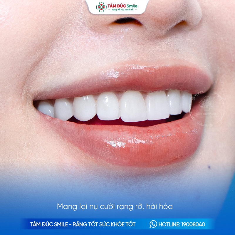 Nha khoa Tâm Đức Smile tư vấn nhiều dòng mặt dán sứ Veneer như E.max, LiSi và Ceramay Pearl theo tình trạng răng và nhu cầu thẩm mỹ.