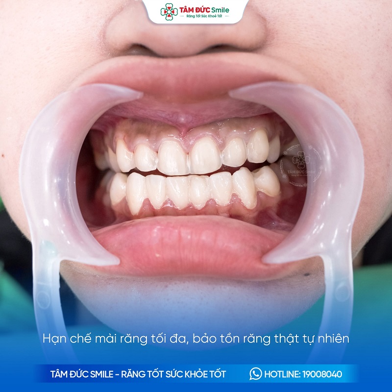 Dán sứ Veneer hạn chế mài răng, ưu tiên bảo tồn tối đa mô răng thật