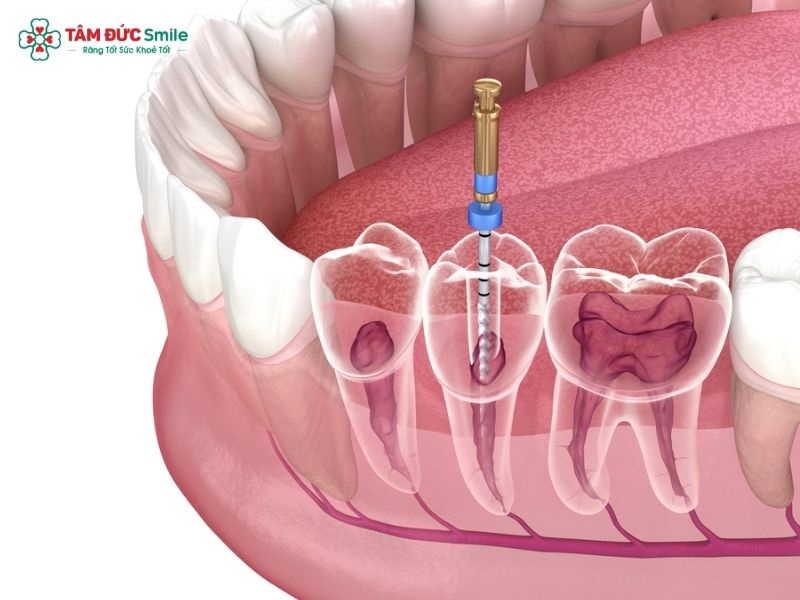 Điều trị tủy răng giúp loại bỏ mô tủy viêm, làm sạch ống tủy và hỗ trợ bảo tồn răng thật.