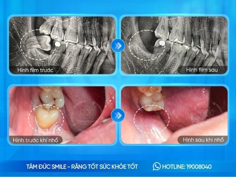 Hình ảnh trước và sau khi nhổ răng khôn tại Nha khoa Tâm Đức Smile