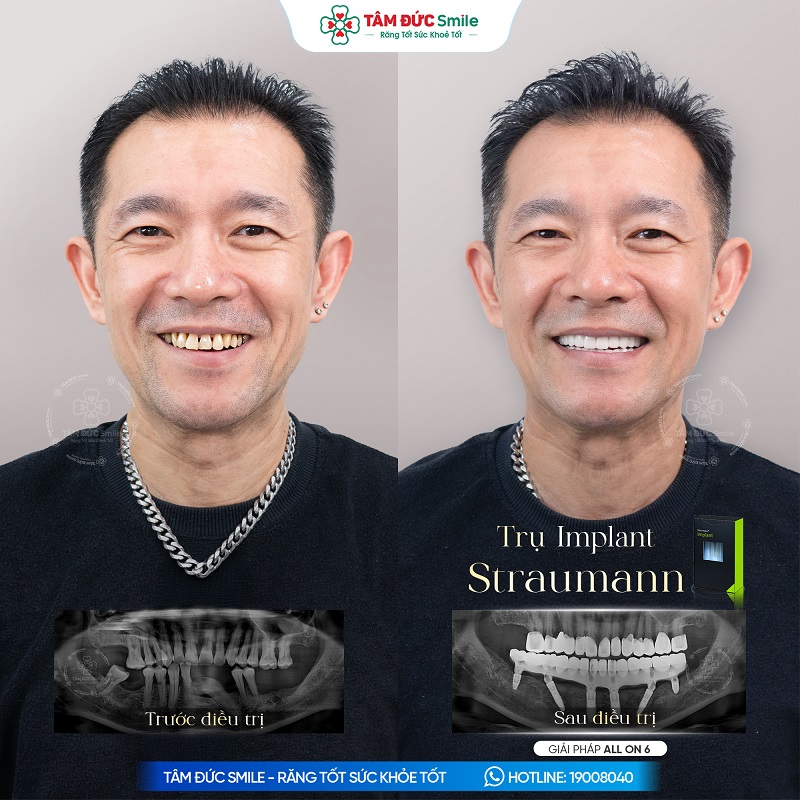 Khách hàng tự tin hơn với nụ cười hài hòa sau khi phục hình răng toàn hàm Implant All on 6.